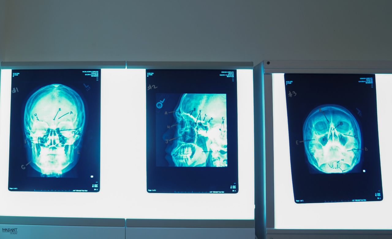 X-ray of the skull on lighted screen