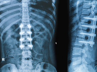 The X-Ray image of a human torso.