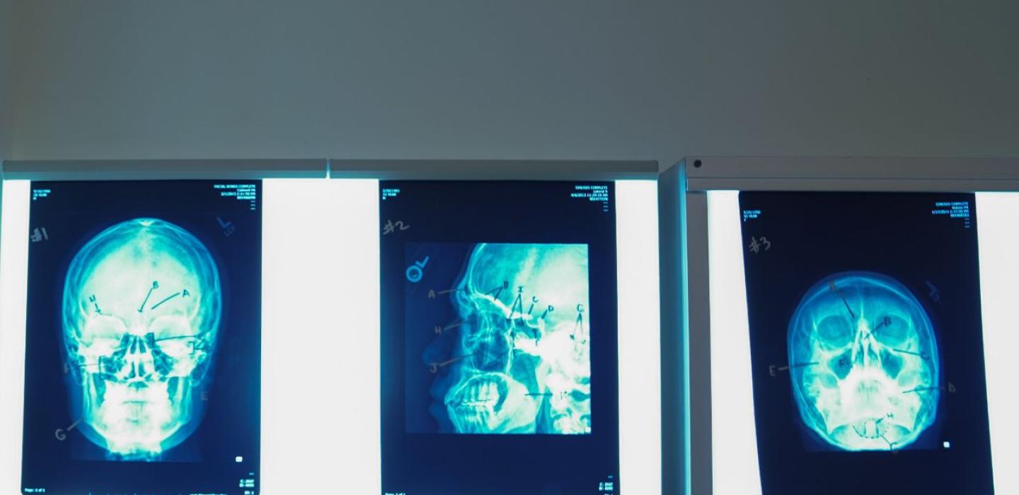 X-ray of the skull on lighted screen